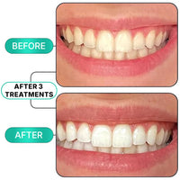 Fang® At-Home Teeth Whitening Pen