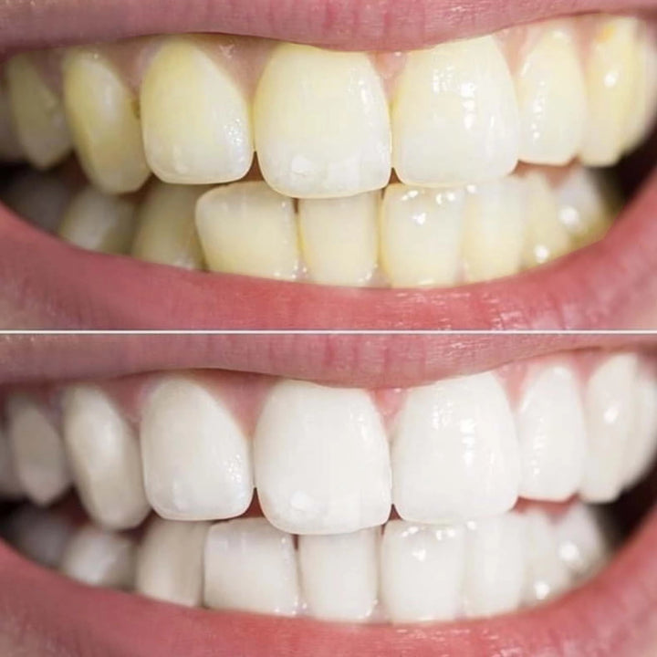 before and after tobacco stains on teeth Understanding Tobacco-Induced Teeth Stains before and after tobacco stains on teeth Understanding Tobacco-Induced Teeth Stains