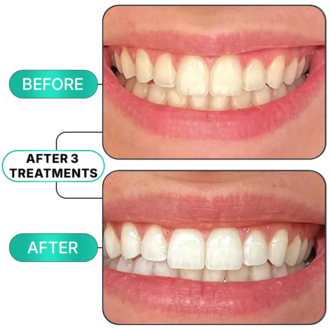 Fang® At-Home Teeth Whitening Pen